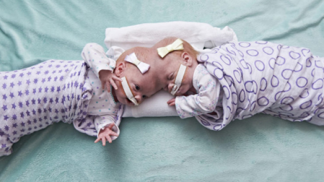 Bergamo, separate due gemelle siamesi (Immagine di repertorio)