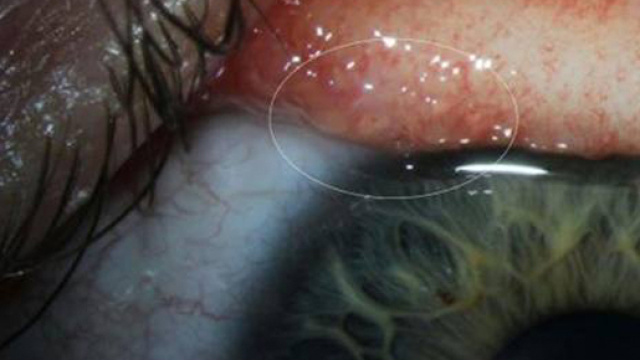 Una ragazza &egrave; stata infettata dalla Thelazia Gulosa