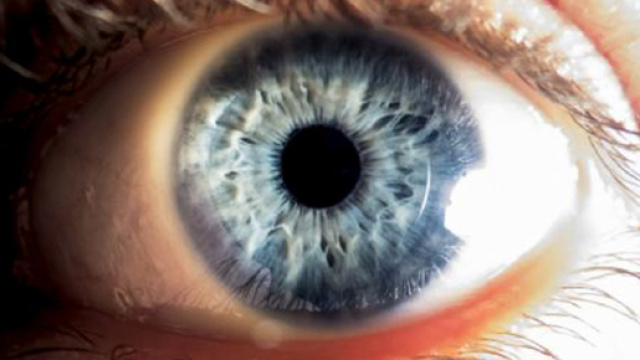Vermi nell'occhio di una paziente: ecco di cosa si tratta