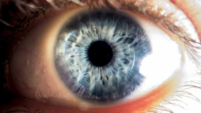 Medici estraggono 14 vermi dall'occhio di una donna.