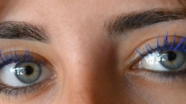 Una ragazza statunitense si &egrave; trovata con 14 vermi parassiti in un occhio