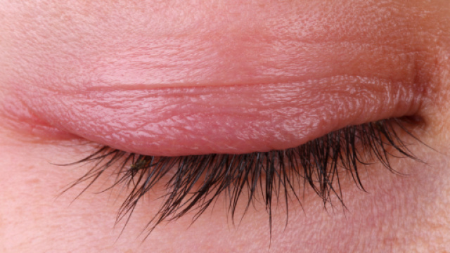 Bruciore all'occhio: trovati 14 vermi, la terribile scoperta dei medici