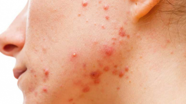 Brufoli: quando lo Stafilococco li causa