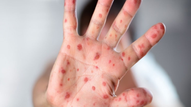 Allarme morbillo: +400% i casi rispetto al 2017 - Impronta Unika - improntaunika.it