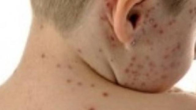 OMS lancia l'allarme Morbillo +400%