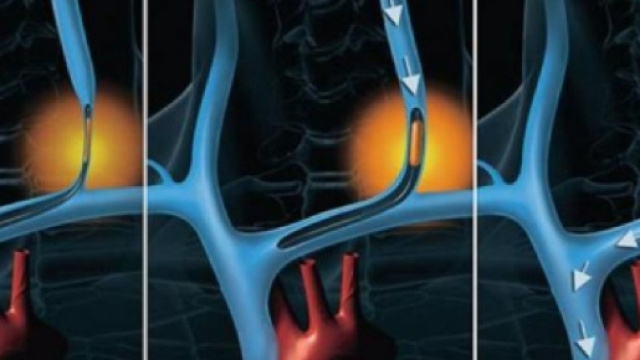Sclerosi Multipla: identificato il meccanismo di riparazione della mielina