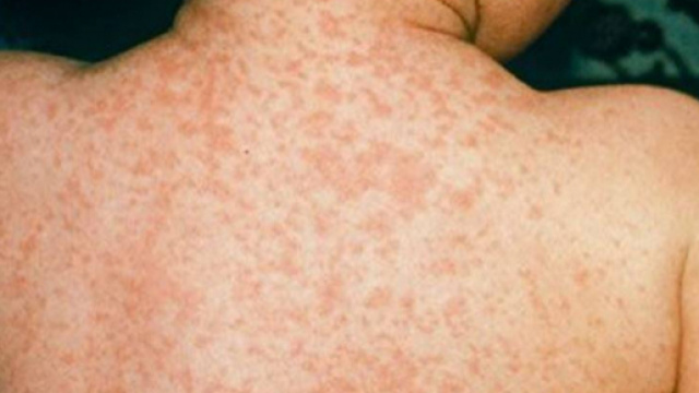 Cosa c'&egrave; dietro i 400 casi di morbillo solo a giugno: nodo vaccini ... - intelligonews.it