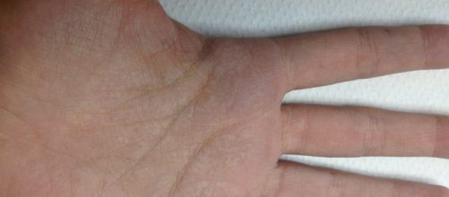 Dermapixel: Si toco agua, se me arrugan las manos - dermapixel.com