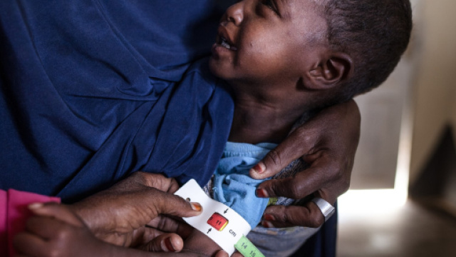 In Somalia, l'Organizzazione Mondiale della Sanit&agrave; stima che 383.000 bambini sotto i cinque anni soffrono di malnutrizione acuta.
