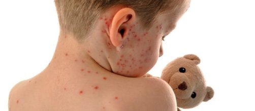 Detectan en Guatemala un posible caso de sarampi&oacute;n 20 a&ntilde;os despu&eacute;s