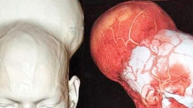 Rimosso il pi&ugrave; grande tumore al mondo: 1,8 chili nel cervello