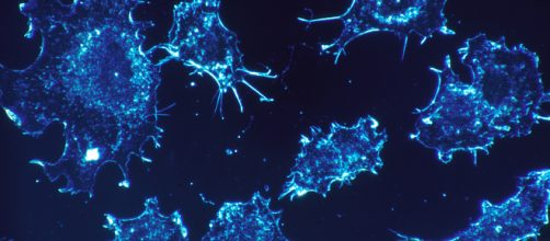 Cancer cells (pictured) can spread throughout the body. (image via Cancer bios/Wikimedia Commons)