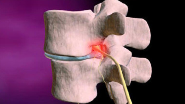 Arthroplastie discale avec proth&egrave;se | E-sant&eacute; - e-sante.be