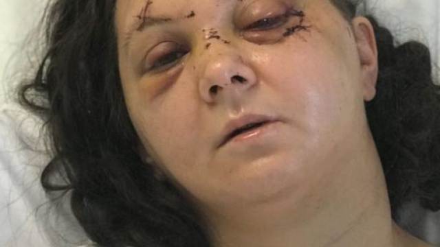 La donna vittima del brutale pestaggio dopo i primi interventi