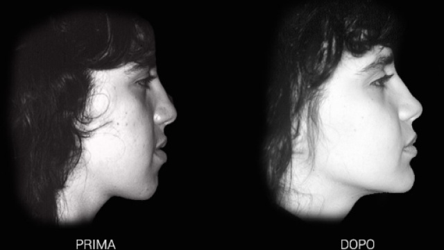 Chirurgia Ortognatica | Chirurgia Maxillo Facciale| Sandro Pelo - sandropelo.it