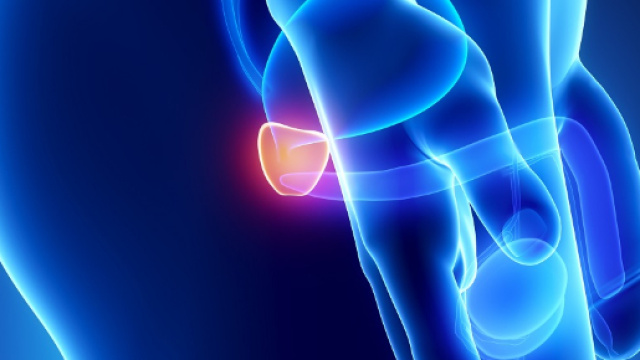 La carenza di vitamina D &egrave; collegata al cancro alla prostata