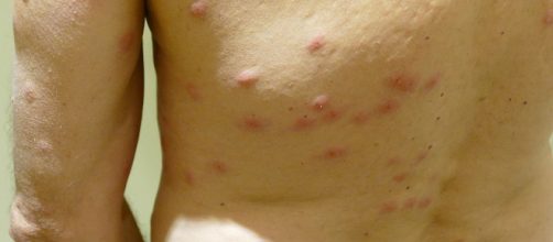 Bed bug bites (Image via Hermann Luyken/Wikimedia)