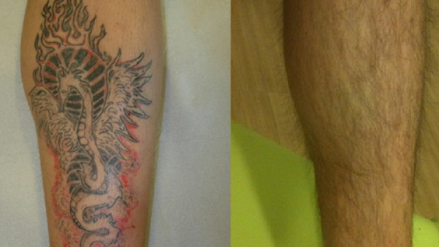 &egrave; possibile eliminare i tatuaggi grazie al sistema immunitario