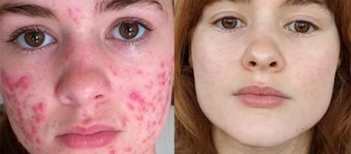 O uso cont&iacute;nuo do tratamento torna-o mais eficaz