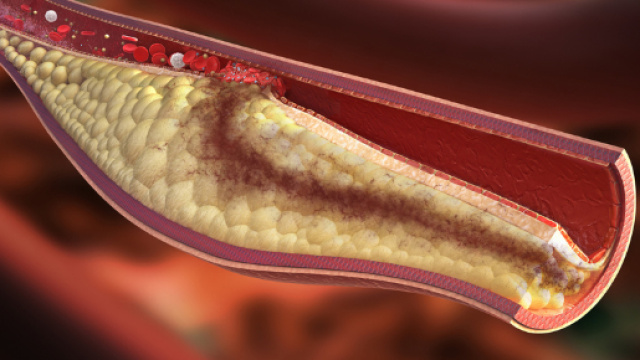 Colesterolo: l'acido bempedoico lo riduce