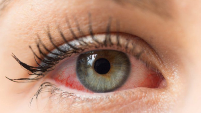 Glaucoma: sintomi e cure - areaoftalmologica.com