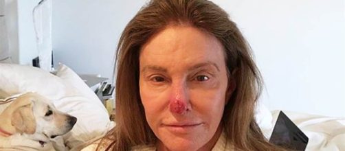 Caitlyn Jenner comparte una foto que muestra el "da&ntilde;o solar ... - celebridadesonline.com