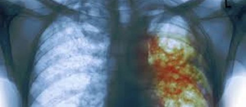 Las cavernas en una Rx de T&oacute;rax, es un signo propio de la Tuberculosis