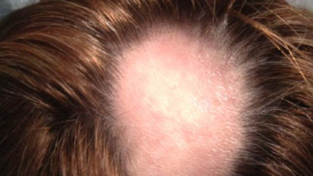 Trattamento prp alopecia aerata femminile | www.calvizieprp.it - calvizieprp.it