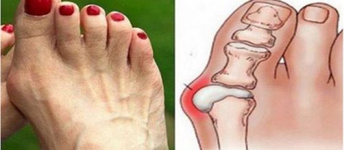 Adem&aacute;s de aplicar con frecuencia los remedios indicados, para evitar los juanetes es fundamental que utilicemos un calzado adecuado