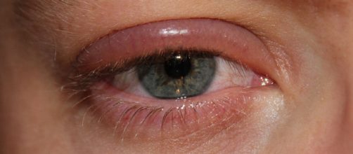 La blefaritis aparece cuando se inflaman las peque&ntilde;as gl&aacute;ndulas seb&aacute;ceas del p&aacute;rpado interno.