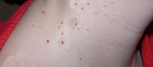 Las verrugas son unas peque&ntilde;as erupciones en la piel causadas por el virus del papiloma humano (VPH).