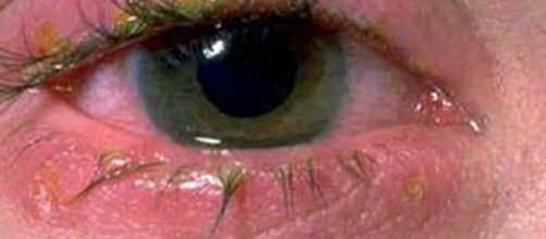 LSi eres propenso a tener conjuntivitis no te pierdas estos remedios naturales para poder aliviar los s&iacute;ntomas