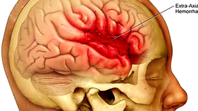 Emorragia cerebrale: cause, sintomi premonitori, diagnosi e cura ... - medicinaonline.co