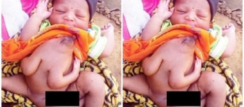 Menina nasce com quatro m&atilde;os e tr&ecirc;s pernas