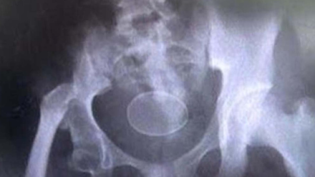 Una radiografia condotta sul 14enne che sta facendo discutere la comunit&agrave; medica locale in Indonesia