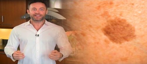 Receita simples para eliminar as manchas marrons.