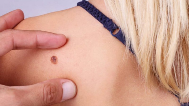 Melanoma: in gravidanza il rischio aumenta - healthgoesup.com