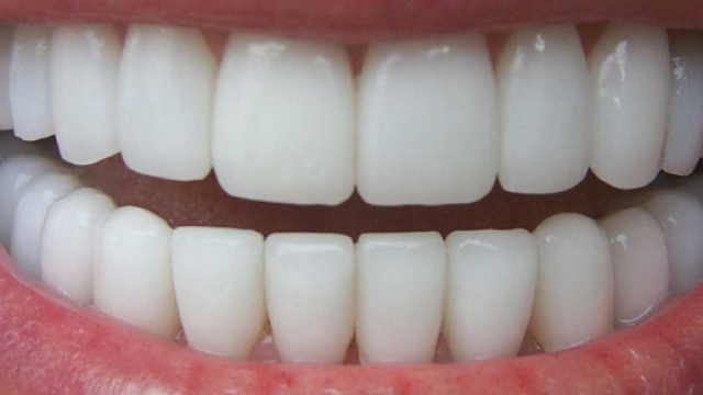 Protesi dentarie, scatta l'allarme di materiali tossici