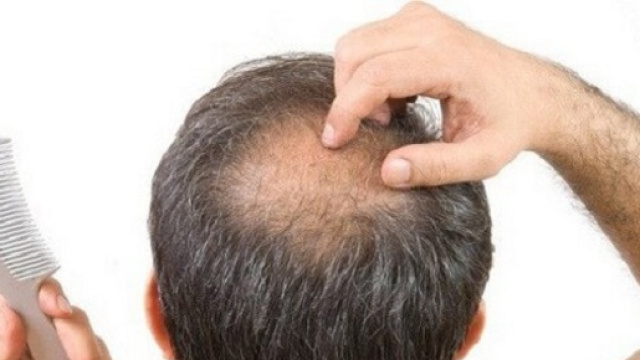 Nuove speranze per la cura della calvizie