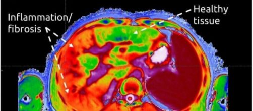 Imagen de LiverMultiScan con tejido sano y tejido inflamado