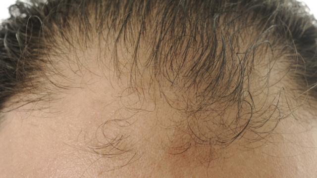 Perdita di capelli e calvizie: la rivelazione di uno studio