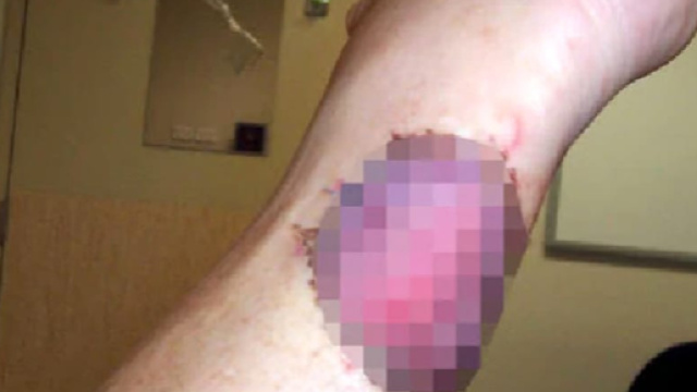 Ulcera carnivora: allarme epidemia in Australia per quella che normalmente &egrave; una malattia rara - foto:nuovarassegna.it