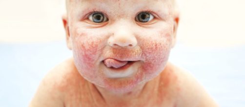 O novo tratamento para dermatite at&oacute;pica