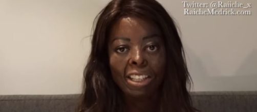Burn Victim who works so others can feel better about being scarred- Image credit Raiche Mederick | YouTube