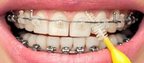 Usa aparelho ortod&ocirc;ntico? Saiba o que muda na hora da higiene bucal