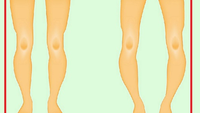 Un nuovo farmaco, un anticorpo monoclonale, &egrave; stato approvato per il trattamento del rachitismo ipofosfatemico.