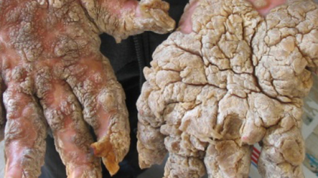 Sindrome dell'uomo pietra: malattia rara che trasforma in 'statue'