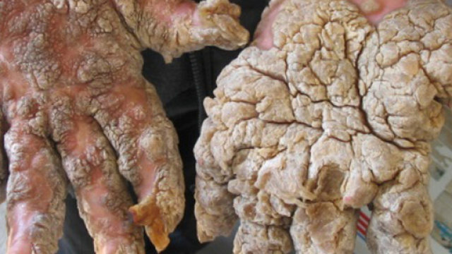 Sindrome uomo pietra: &egrave; come vivere all'interno di una gabbia senza via uscita