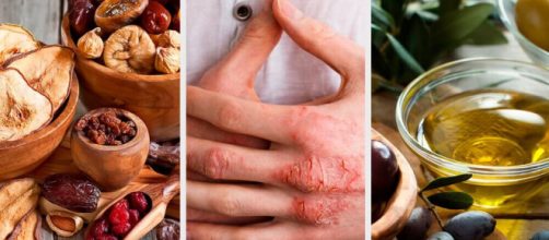 Dermatite at&oacute;pica: acabe com as coceiras com esses tratamentos naturais