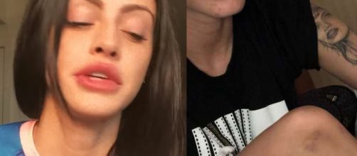 Ex-mulher de Biel mostra cicatrizes. (Foto: Divulga&ccedil;&atilde;o)